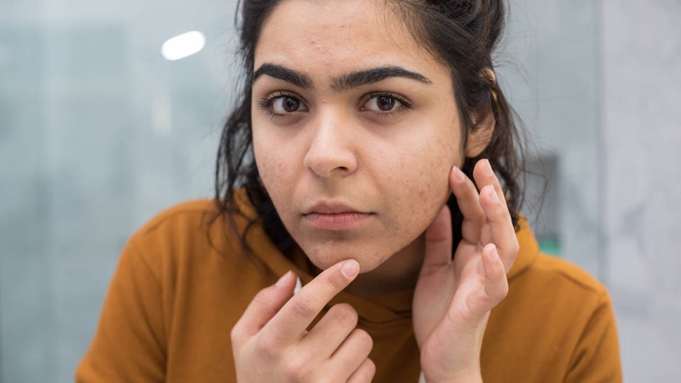 11 Surprising Reasons You Still Have Acne Despite Trying To Get