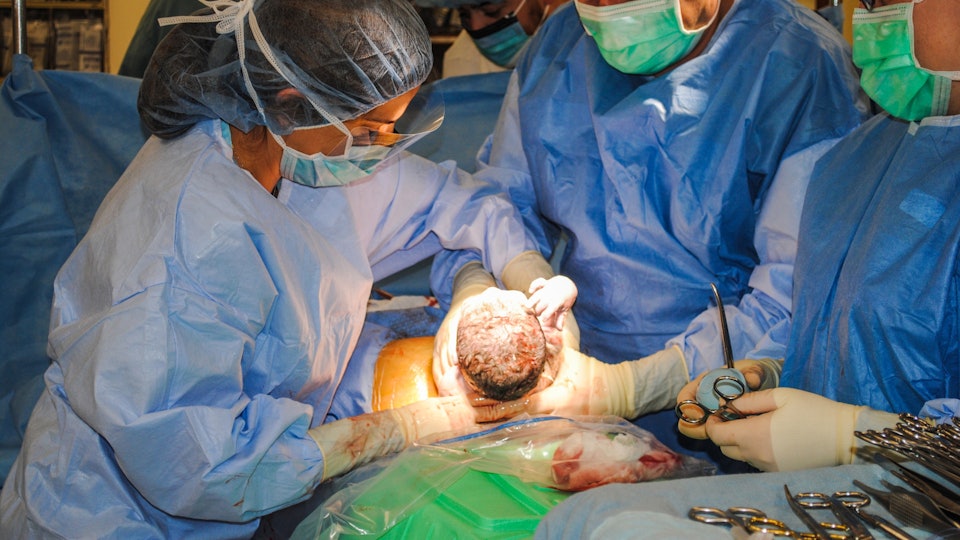 How Safe Are Repeat C Sections Here S How They Affect Your Body
