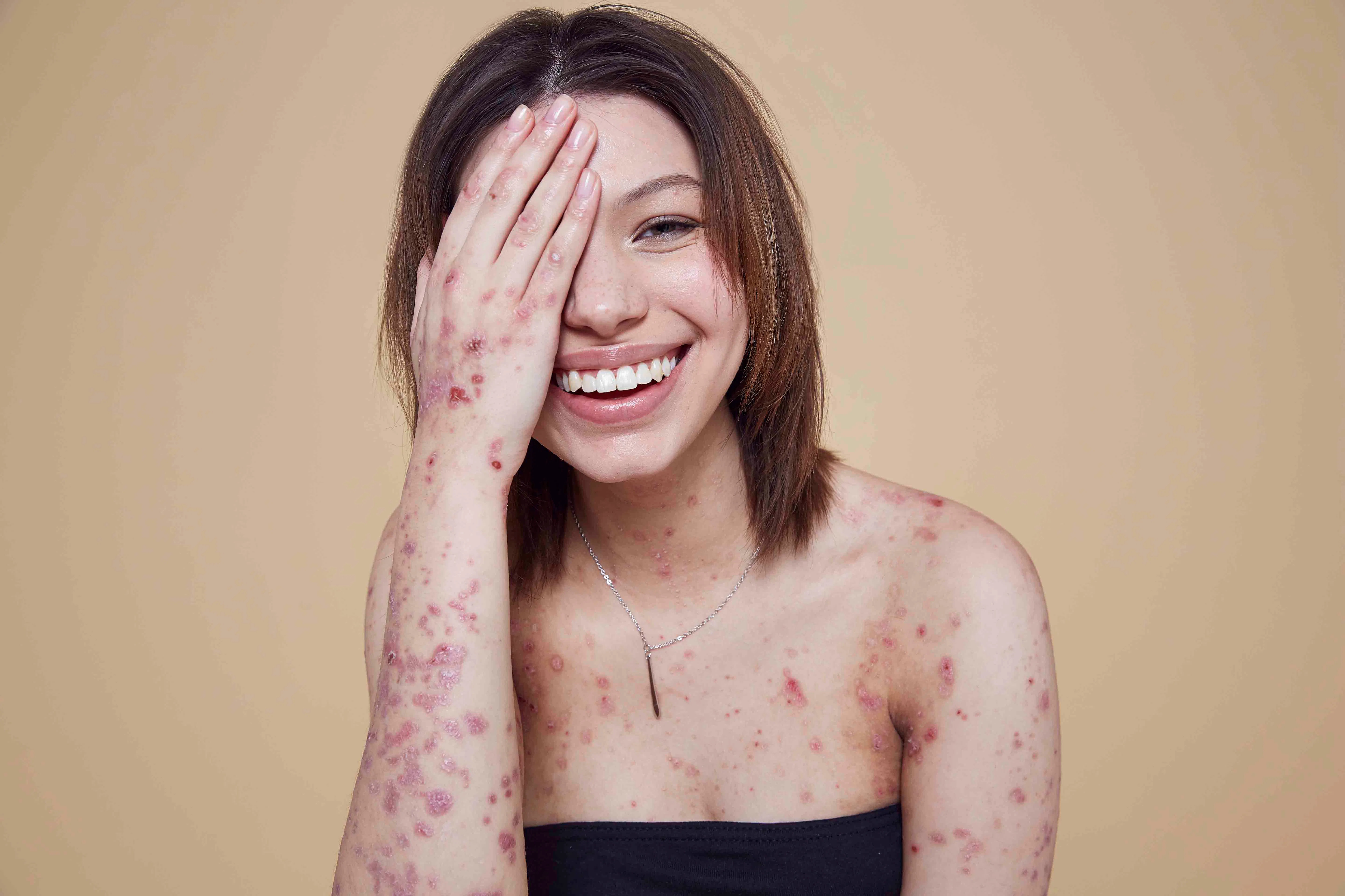 Missguided's #InYourOwnSkin Campaign Celebrates Models With Skin Conditions