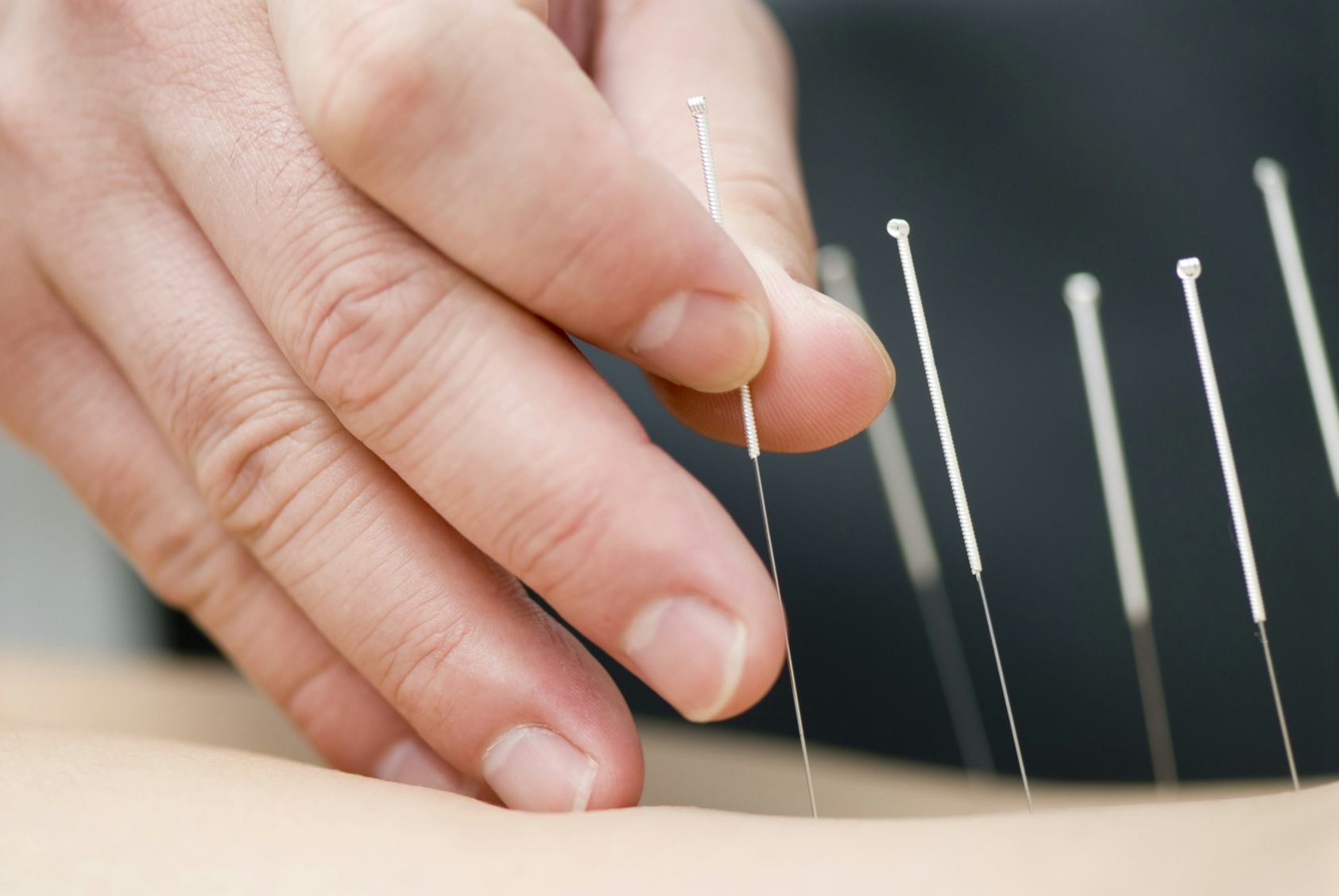 What To Expect At An Acupuncture Appointment So You Know Before You Go