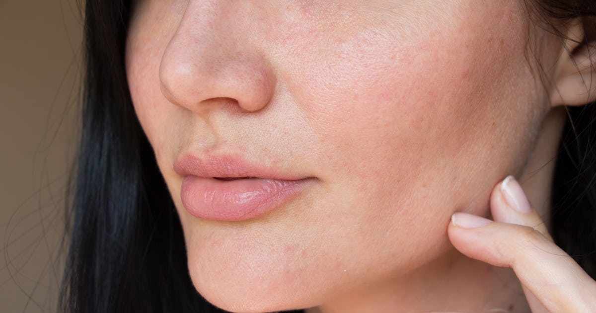 Ingrown lip hair Clearance