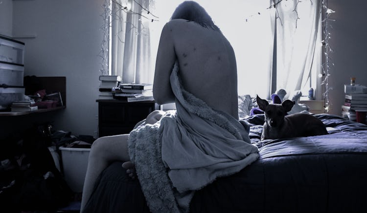 A girl with endometriosis sitting naked and covered with a towel on the edge of a bed