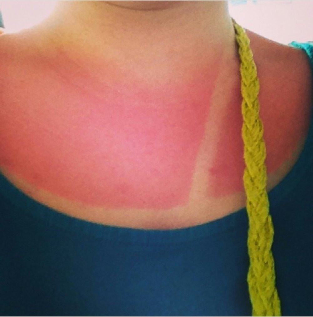 These Sunburn Horror Stories Will Remind You That SPF Is A Blessing