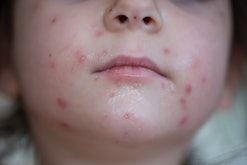 Kid with chickenpox