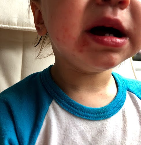 How To Treat Hand, Foot, & Mouth Disease In Toddlers, Because