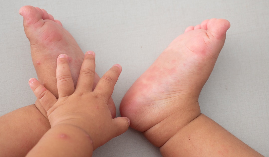 How To Treat Hand, Foot, & Mouth Disease In Toddlers