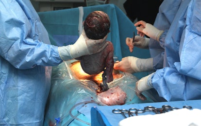 Doctors hold a newborn in their arms after performing a caesarean section