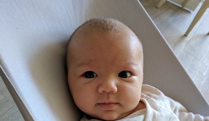 A baby with a cradle cap resting in a chair.