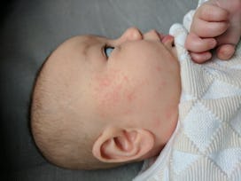 Baby with Eczema turned to a side.