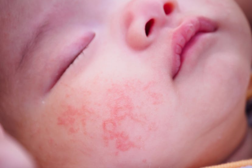 Baby with Eczema on her face