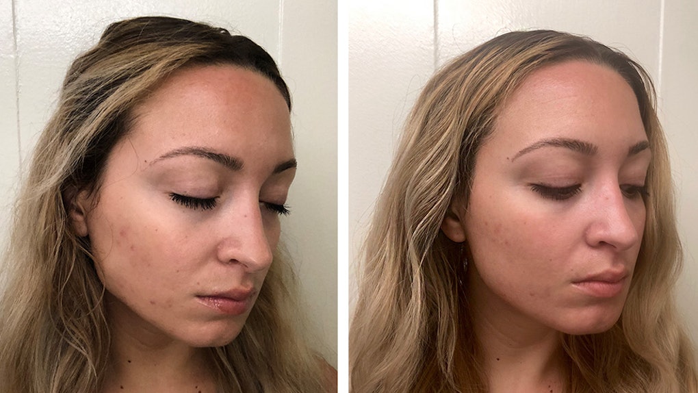 I Tried The Clear Brilliant Treatment For More Balanced Even Skin Couldn T Be Happier With The Results