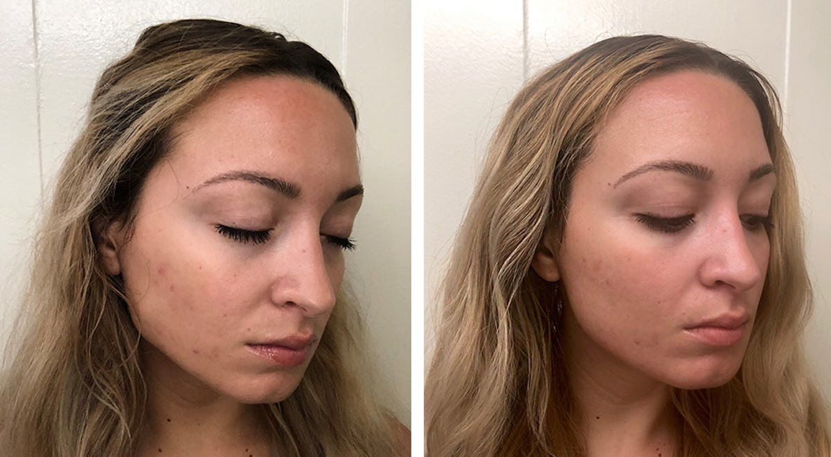 I Tried The Clear Brilliant Treatment For More Balanced Even Skin Couldn T Be Happier With The Results I Tried The Clear Brilliant Treatment For More Balanced Even Skin Couldn T Be Happier With The Results