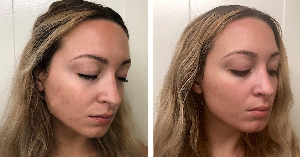 I Tried The Clear Brilliant Treatment For More Balanced Even Skin Couldn T Be Happier With The Results