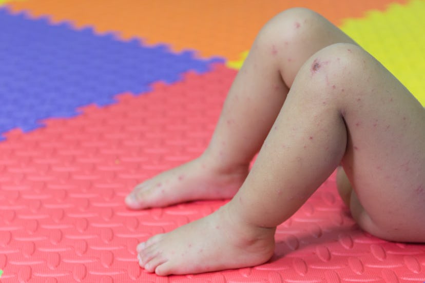 A child's legs and feet covered with disease bruise-like spots