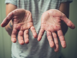 An adult man's hand with a disease all over his palms and fingers