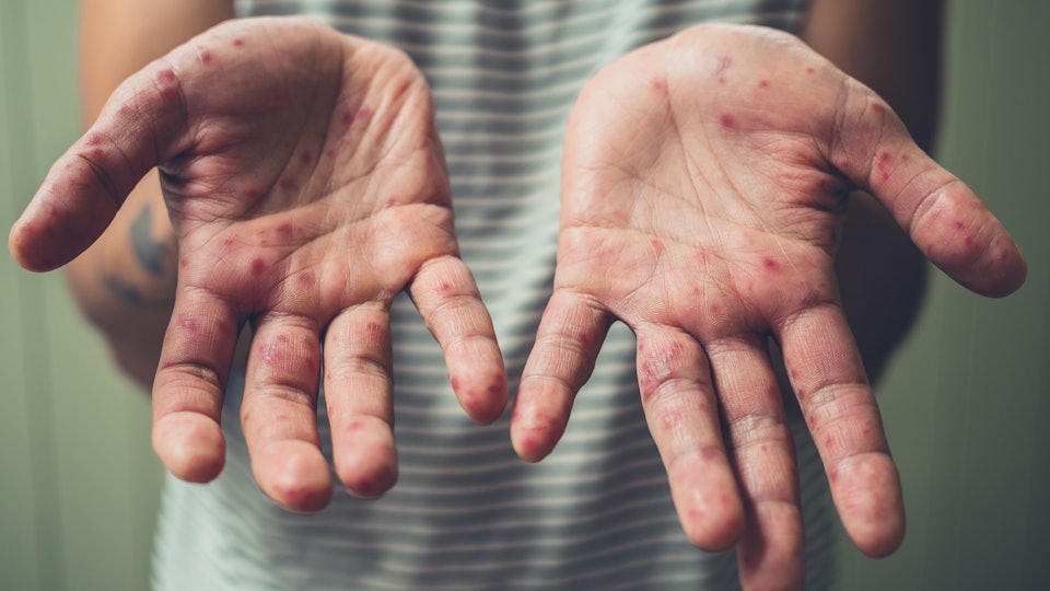 Hand Foot And Mouth Disease Symptoms In Adults