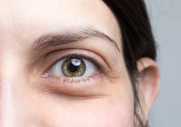 7 Shocking Things It Means If You Have Dark Circles Under Your Eyes