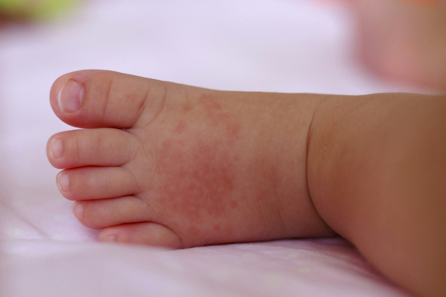 What's The Difference Between Measles & Heat Rash? Here's What A ...