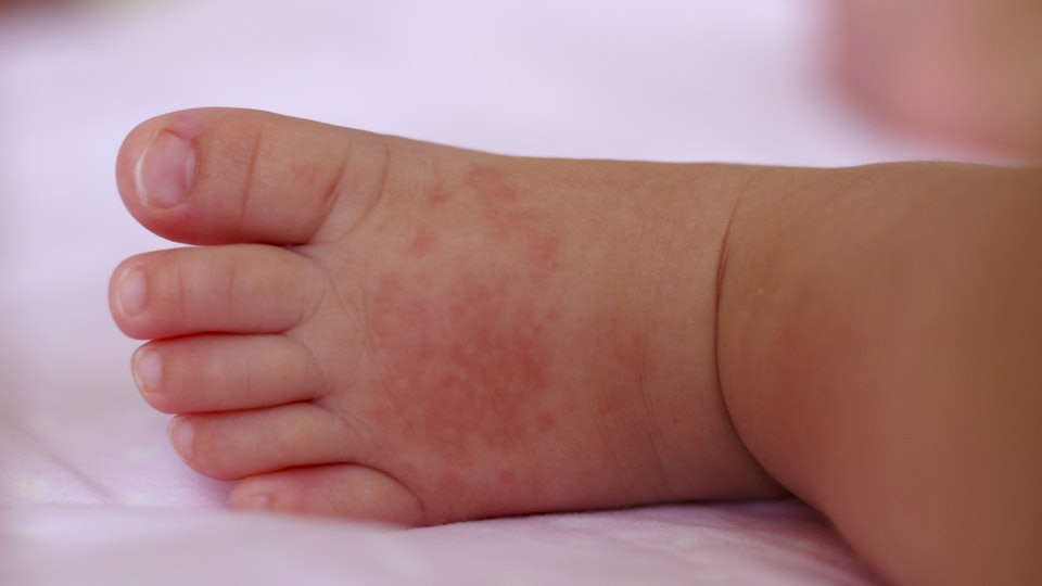 What's The Difference Between Measles & Heat Rash? Here's What A