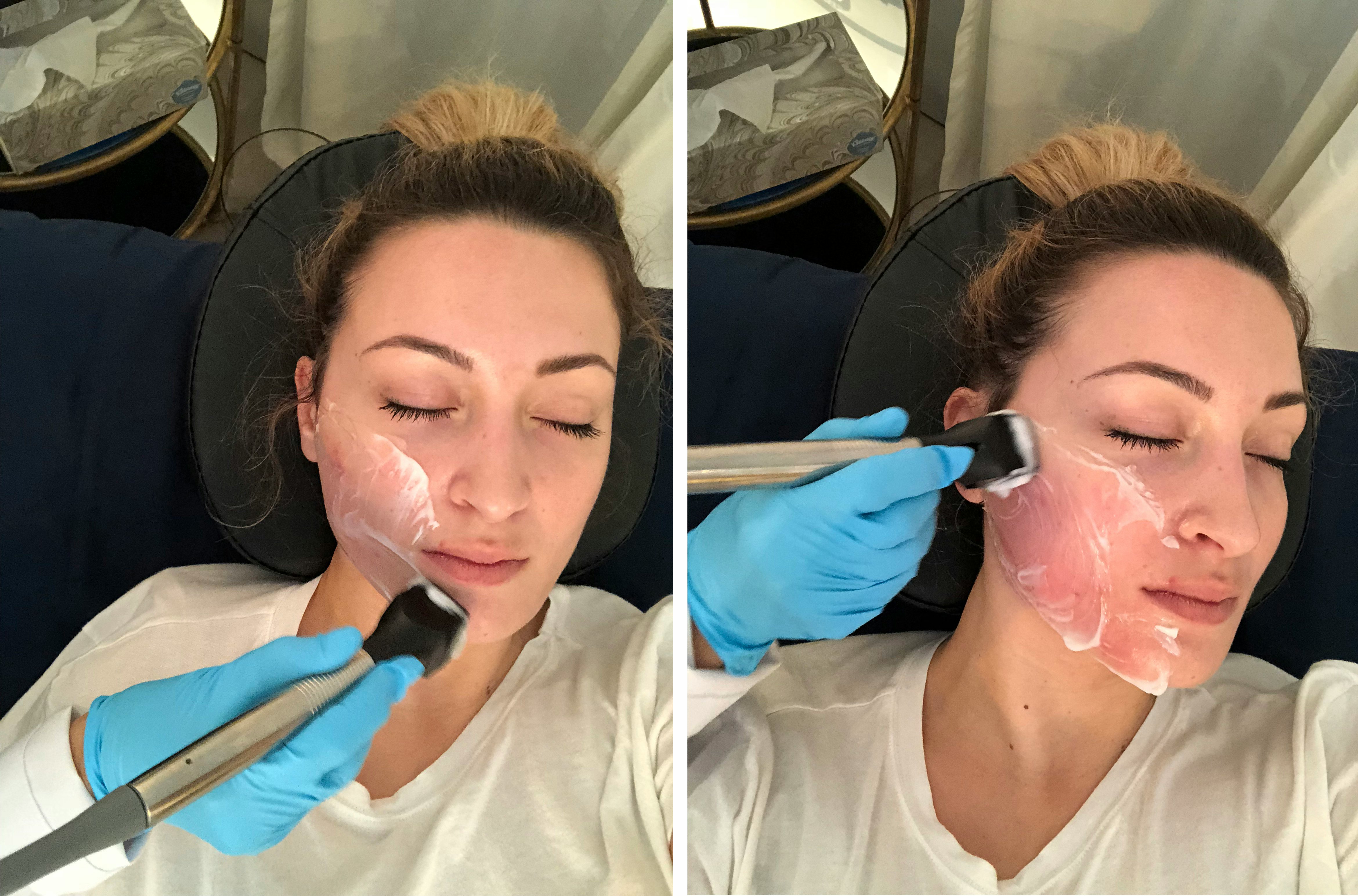 I Tried The Forma Non Surgical Facelift It Completely Sculpted