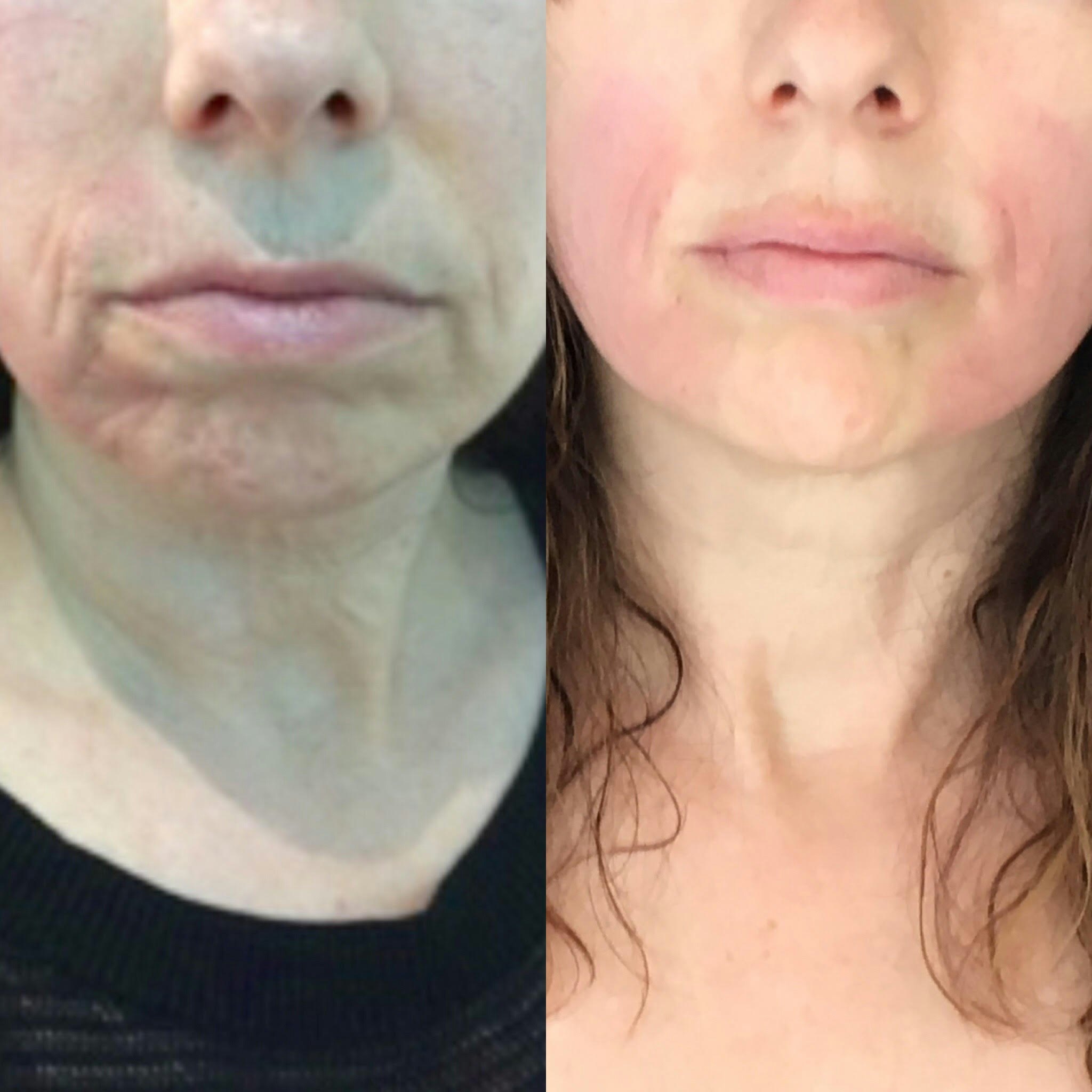 I Tried The Forma Non Surgical Facelift It Completely Sculpted
