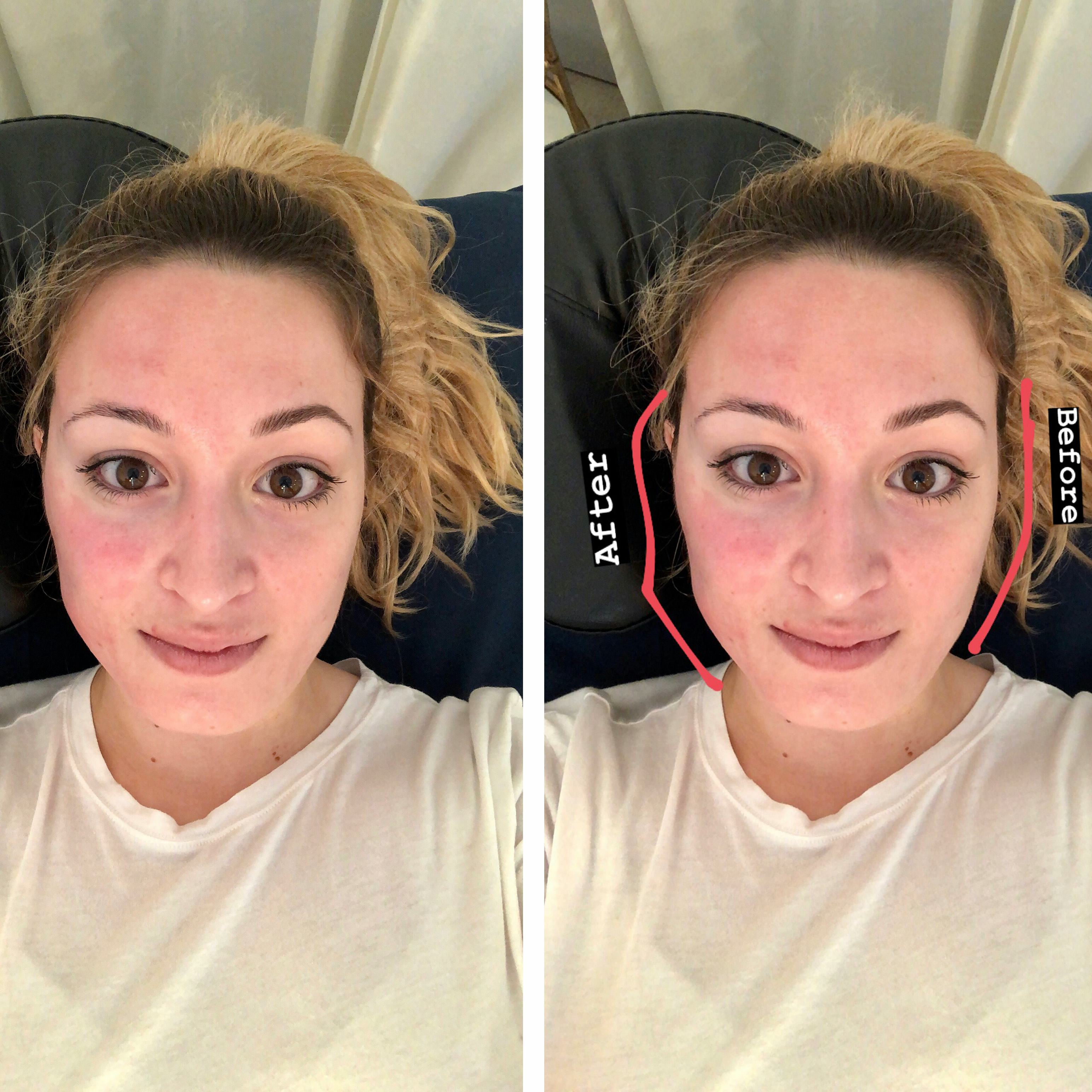 I Tried The Forma Non-Surgical Facelift & It Completely Sculpted My Face