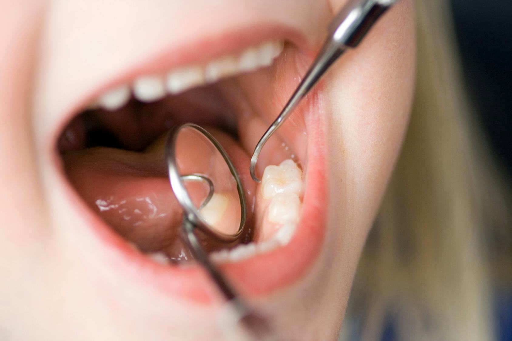 baby molars coming in