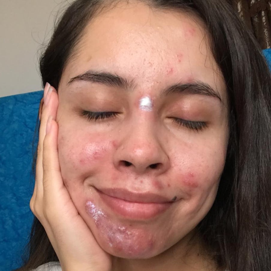 A makeup artist turned her acne into stars in a viral makeup look forecast A makeup artist turned her acne into stars in a viral makeup look recommend