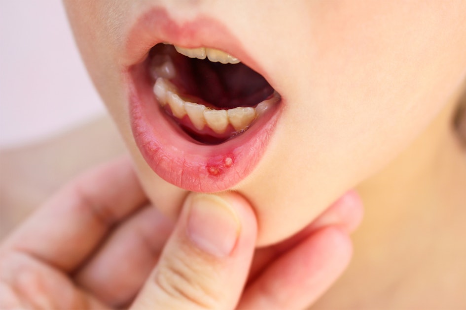 How To Relieve A Canker Sore In A Child With This "Magic