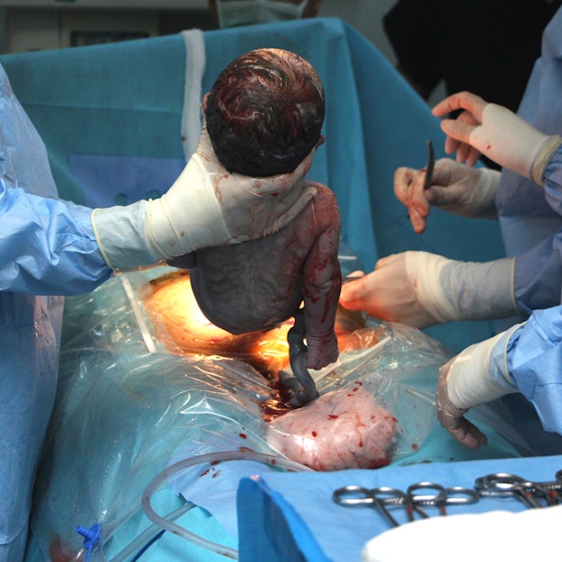 An OB-GYN delivering a baby during childbirth in a hospital room with two assistants