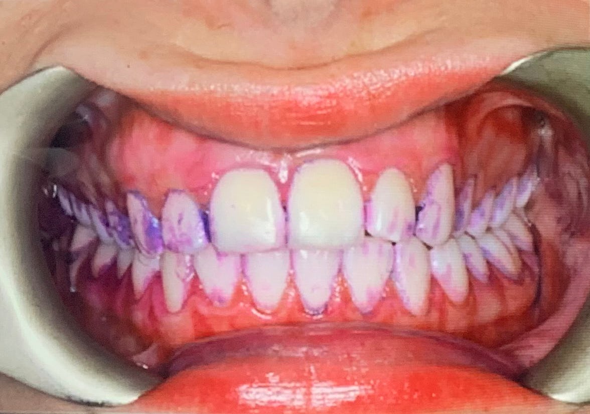 Does Tooth Polishing Actually Work? I Tried It & This Is What I Thought