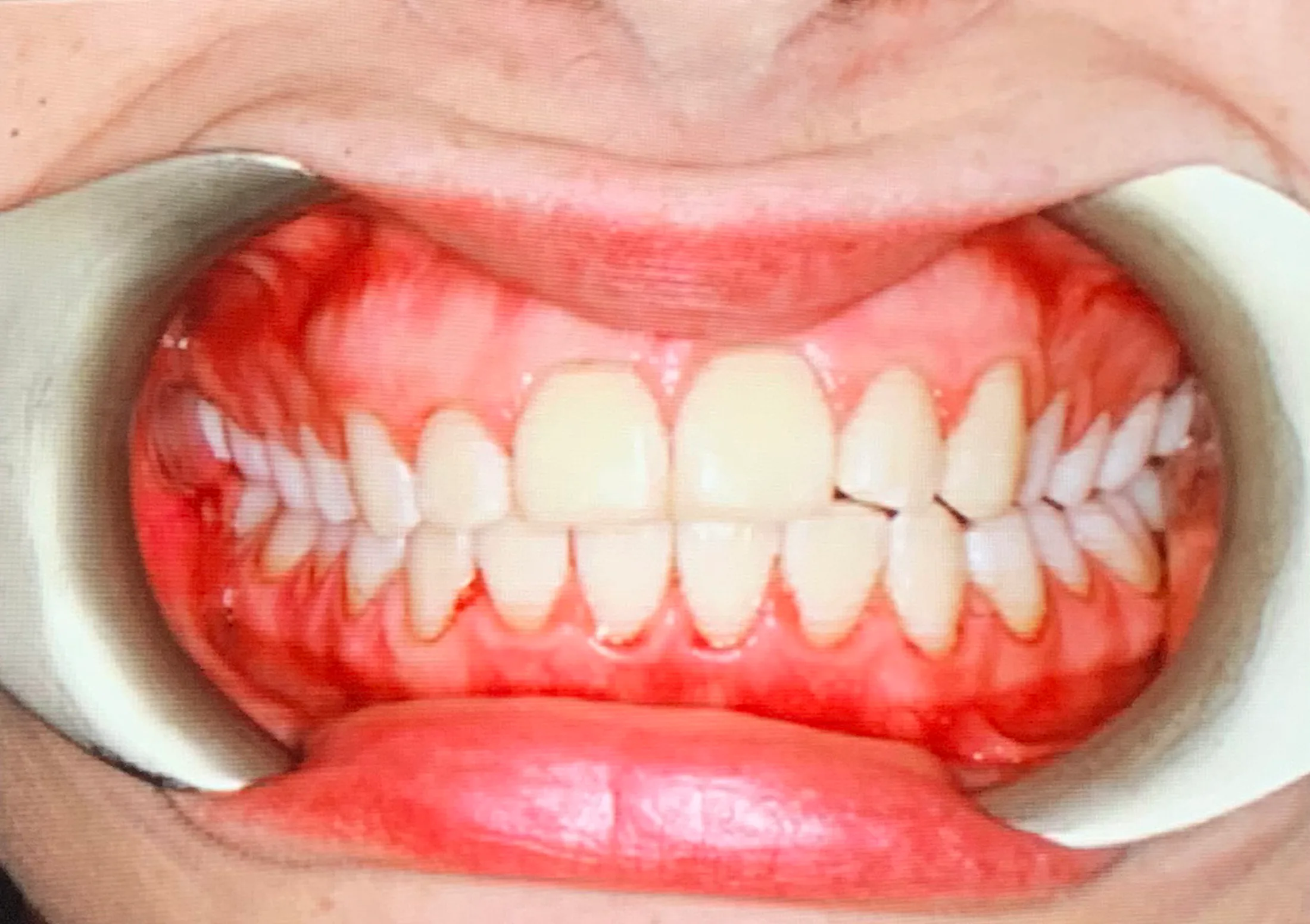 Bussel Teeth Does Tooth Polishing Actually Work? I Tried It & This Is What I Thought
