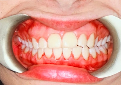 Photos are taken after Airflow advanced tooth polishing to show the difference