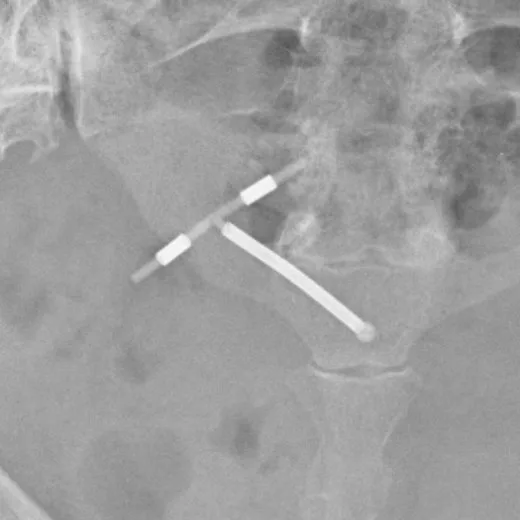 iud and smoking cigarettes That Has Been Installed 5 Stock Photo 2714178847 The Link Between Smoking and