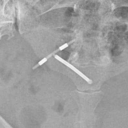 An IUD on an X-ray. Some people with IUDs report serious adverse health effects and have to have the...