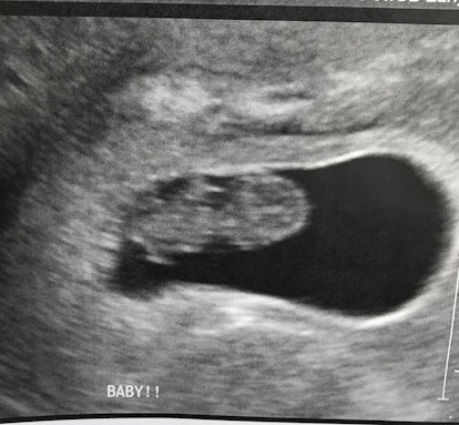 A screenshot from an ultra-sound and the text 'BABY!'
