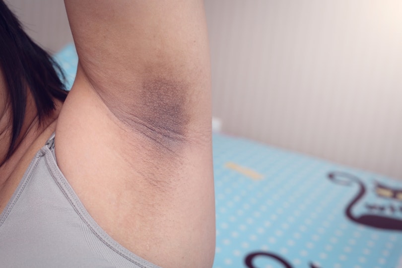 8 Shocking Things It Can Mean If You Have Dark Armpits