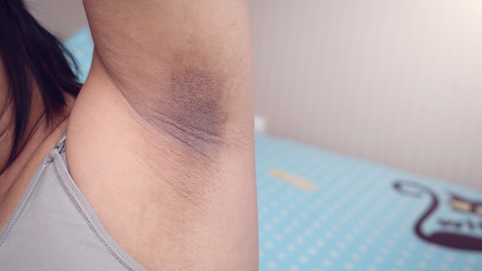 8 Shocking Things It Can Mean If You Have Dark Armpits