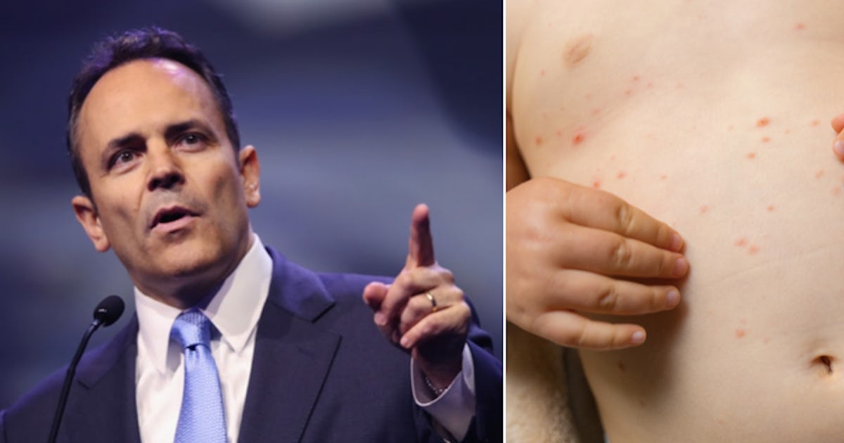 Governor Says His Kids "Got The Chickenpox On Purpose" Instead Of