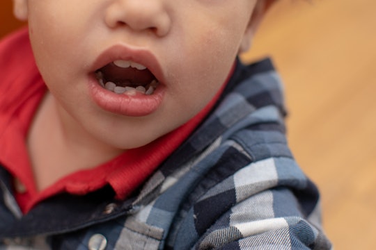 Can Toddlers Get Cold Sores It S More Common Than You Think