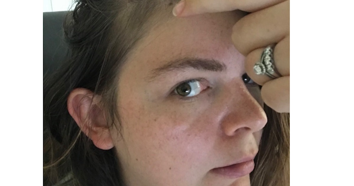 Postpartum Hair Loss At Temples Is Incredibly Frustrating But
