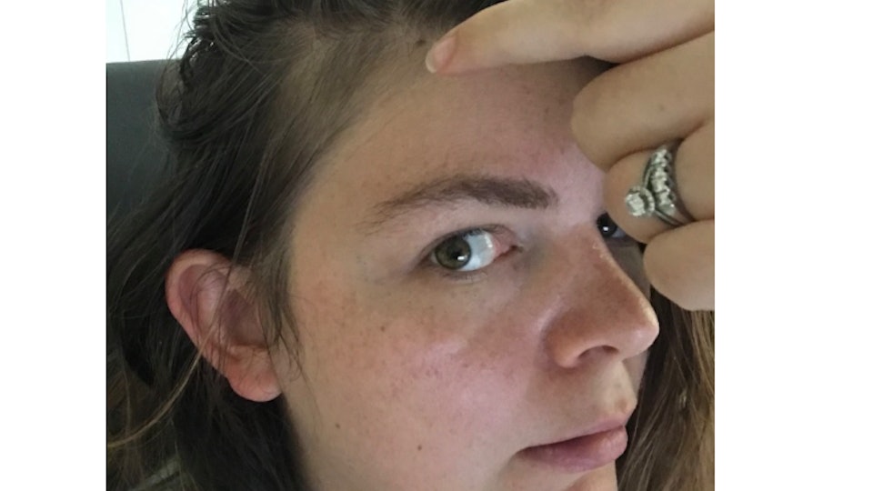 Postpartum Hair Loss At Temples Is Incredibly Frustrating But