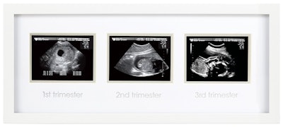 Triple Sonogram Pregnancy Keepsake Frame