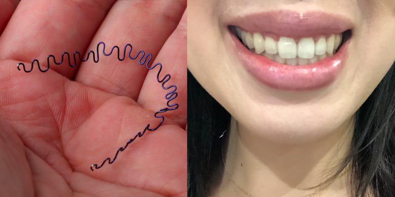 I Got Invisible Aka Lingual Braces As An Adult I Noticed A Shift In My Teeth In Just Two Months