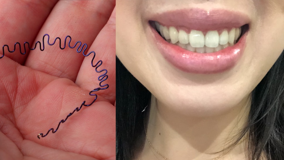 braces lingual noticed