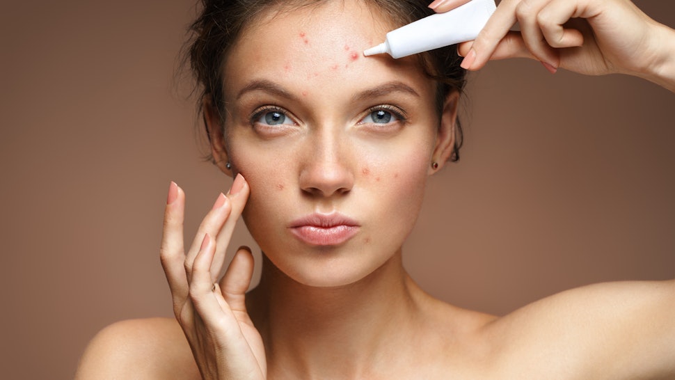 why did i suddenly get back acne