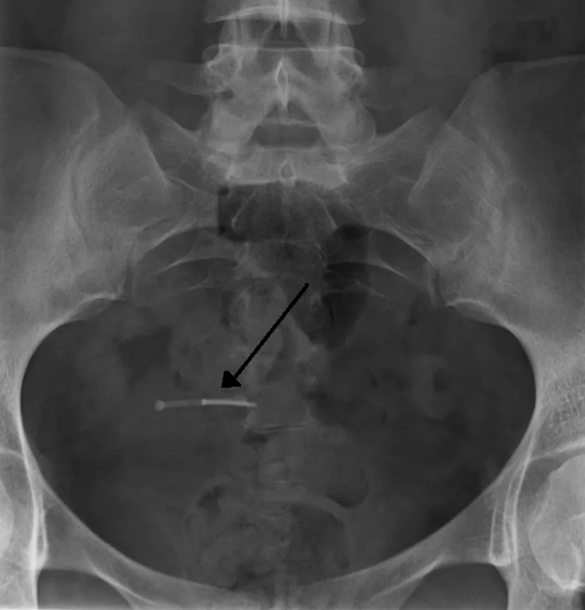 Iud Rash 5 Facts About IUDs No One Tells You Before You Get One, According To 7 ...