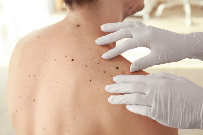 A person getting their back checked, because he's terrified of skin cancer