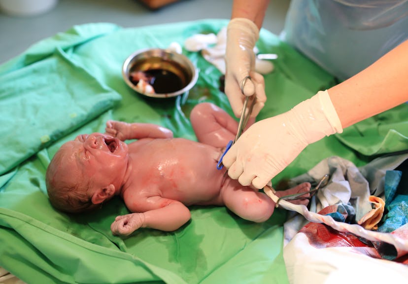A newborn baby on a table while its umbilical cord is being cut