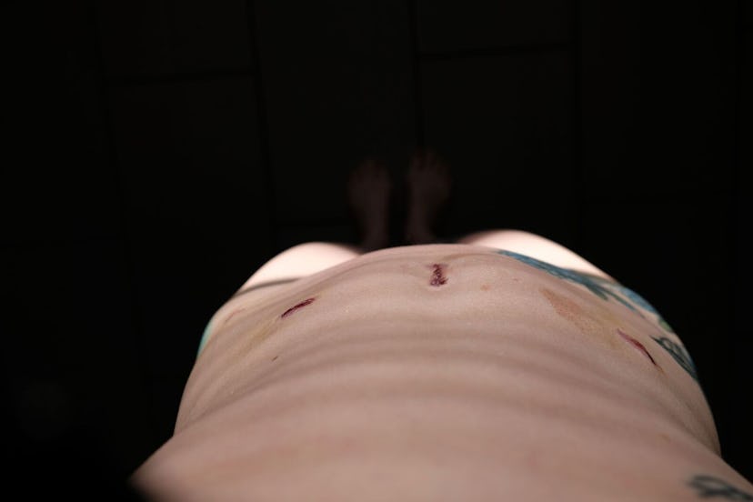 Stitches on the abdomen of a person after a hysterectomy